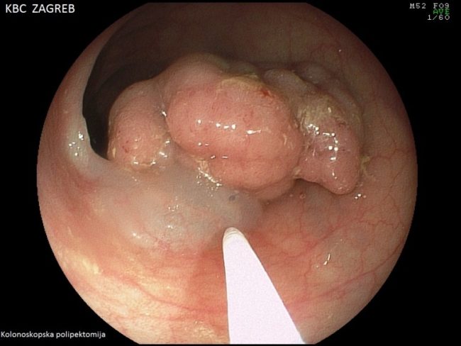 Aplikacija otopine 0,9% NaCl-a i adrenalina iglom za sklerozaciju